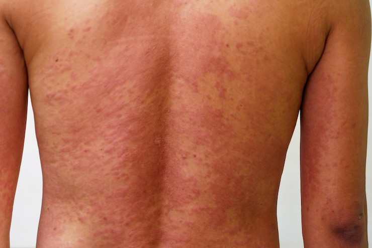 Foto jovem com erupção cutânea da alergia a drogas