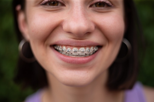 Foto jovem garota com penteado bob e camiseta puðºple sorrindo com aparelho dentário de metal para correção de mordida nos dentes