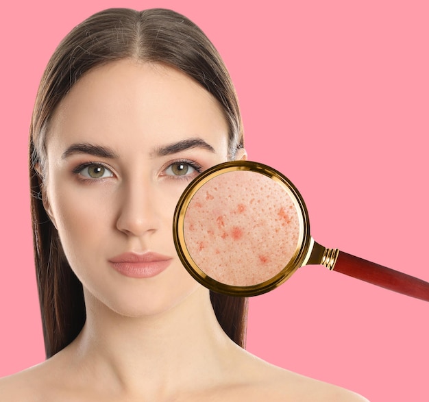 Foto jovem mulher com problema de acne em fundo rosa pele sob lupa