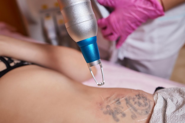 Jovem passando por procedimento de remoção de tatuagem a laser em close do salão