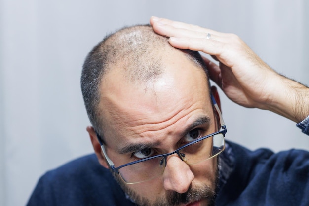 Joven con alopecia mirándose la cabeza y el pelo en el espejo