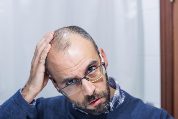 Joven con alopecia mirándose la cabeza y el pelo en el espejo