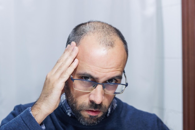 Joven con alopecia mirándose la cabeza y el pelo en el espejo