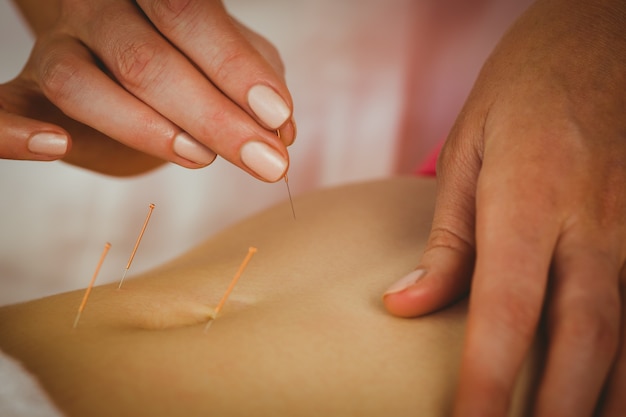 Joven mujer recibiendo tratamiento de acupuntura en la sala de terapia