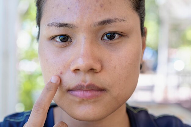 Junge asiatische Frau kümmert sich um ihr Gesicht, wenn sie Probleme mit der Haut auf ihrem Gesicht in einer Natur hat