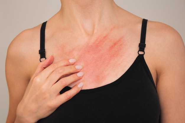junge Frau kratzt sich an der Brust und leidet an Allergien, Juckreiz, Hautausschlag und Dermatitis