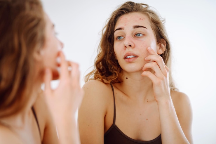 Foto junge frau sieht sich im spiegel an und untersucht entzündungen an ihrem gesicht akne haut medizin und kosmetik