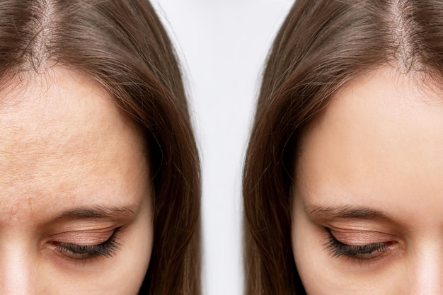 Junge kaukasische Frau mit Falten auf der Stirn vor und nach dem Facelift-Botox-Verfahren