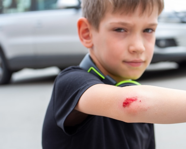 Junge mit einer frischen Wunde am Arm, Ellbogen mit Blut. Mann verletzte sich nach dem Sturz die Hand. Medizinisches Gesundheitskonzept.