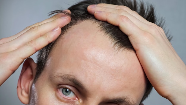 Junger Mann mit kahlen Stellen, der an Haarausfall leidet