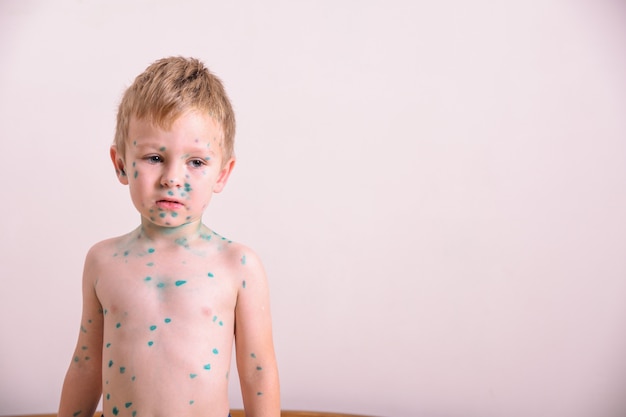 Junges Kleinkind, Junge mit Windpocken. Krankes Kind mit Windpocken. Varizellenvirus oder Windpockenblasenausschlag auf Körper und Gesicht des Kindes.