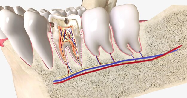 Foto karies oder karies sind bereiche mit karies, die durch säureproduzierende bakterien im mund verursacht werden
