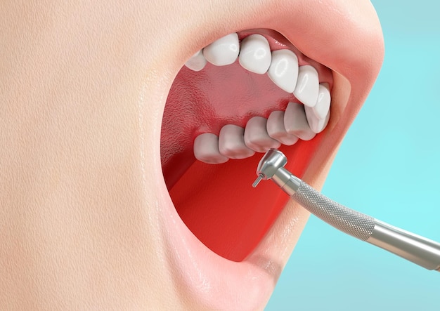Kariesentfernungsprozess bei menschlichen Zähnen mit einer Bohrmaschine
