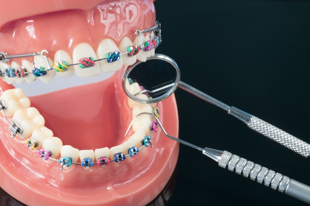 Kieferorthopädisches Modell und Zahnarztwerkzeug - Demonstrationszahnmodell für verschiedene kieferorthopädische Brackets oder Zahnspangen