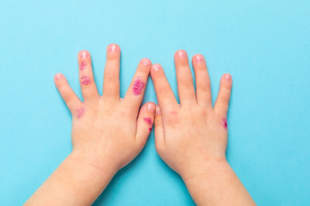 Kinderhand mit Dermatitis. Ekzem zur Hand. Auf dem blauen Hintergrund isoliert