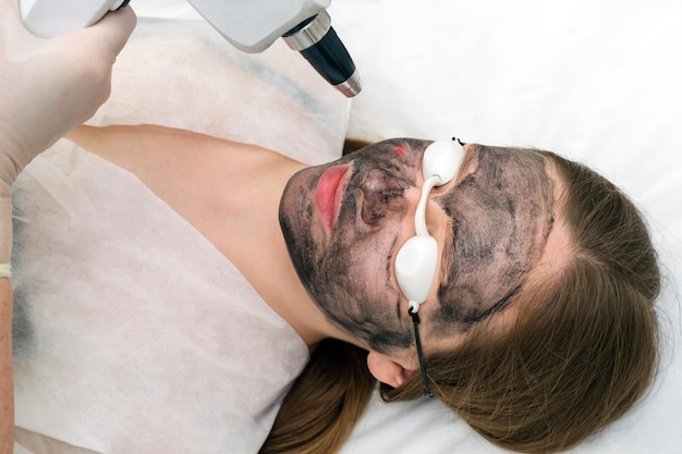 Kohlenstoff-Peeling des Gesichts einer jungen schönen Frau Peeling-Hauterneuerungs-Laserpunkt