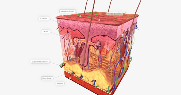 Foto kontaktdermatitis im hautgewebe