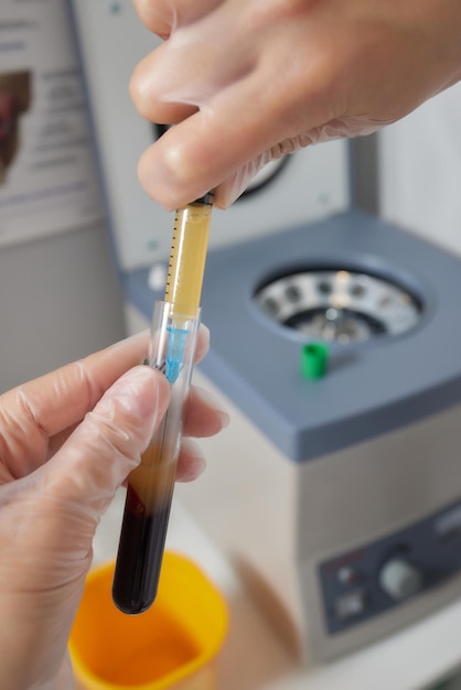 Kosmetiker Ärzte legen Reagenzglas mit Blut in Zentrifugenbehälter Verjüngung Plasmolifting