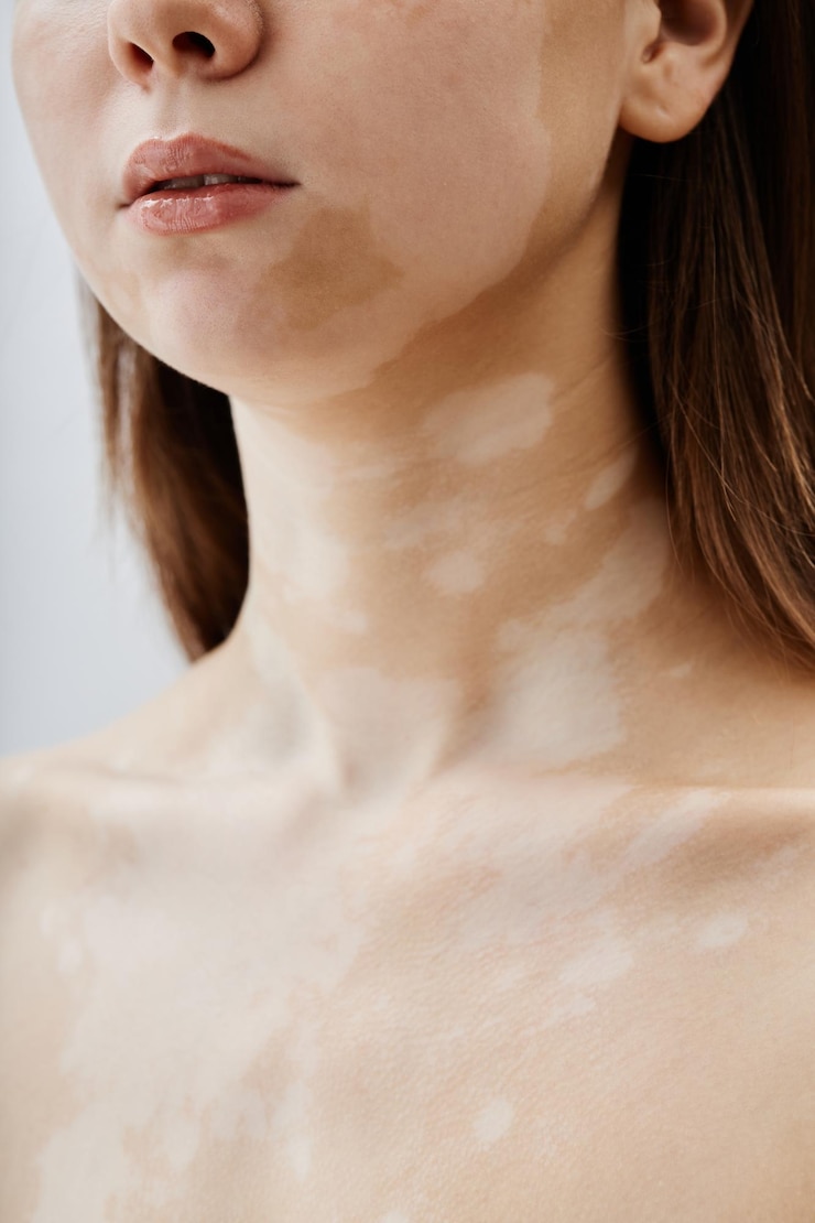 Foto lábios e ombros nus de menina com manchas de vitiligo na pele posando em estúdio