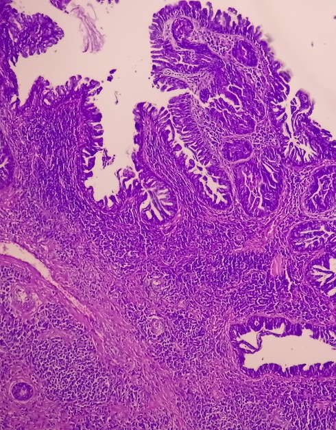 Lâmina histológica sob microscopia mostrando papiloma escamoso pedunculado