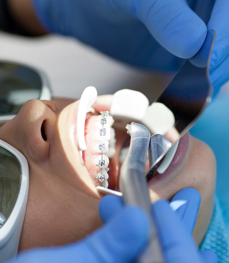 Laser dental usado em um paciente em tecidos moles e duros. Saúde bucal, tecnologia moderna e conceito de higiene bucal.