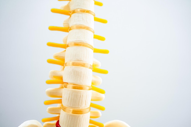 Lendenwirbelsäule verschobenes Bandscheibenfragment, Spinalnerv und Knochen. Modell zur medizinischen Behandlung in der orthopädischen Abteilung.