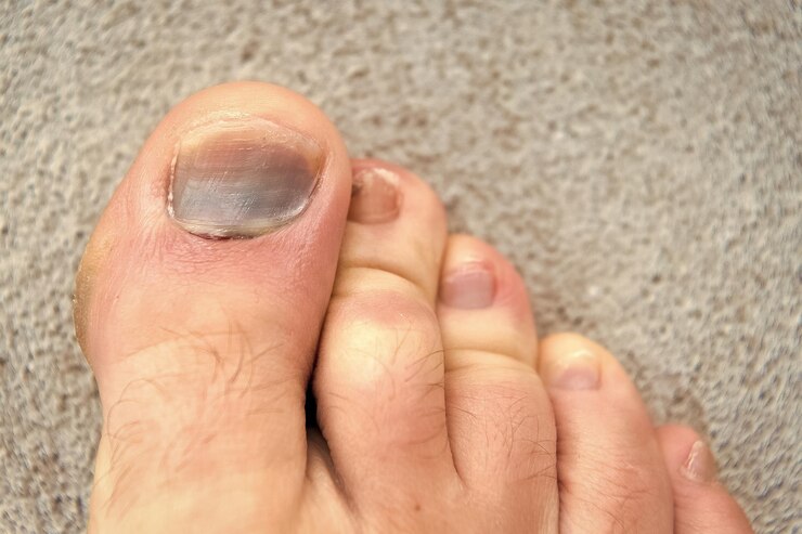Foto lesão no dedo do pé, hematoma e tratamento de trauma, intervenção médica, fratura, sapatos desconfortáveis, fungos nas unhas