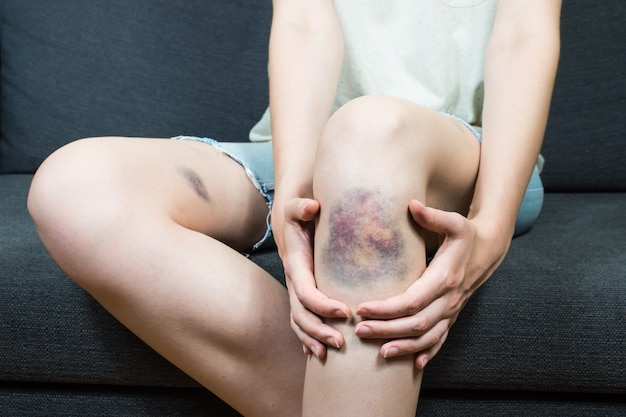 Foto lesión por hematoma en la rodilla de una mujer joven