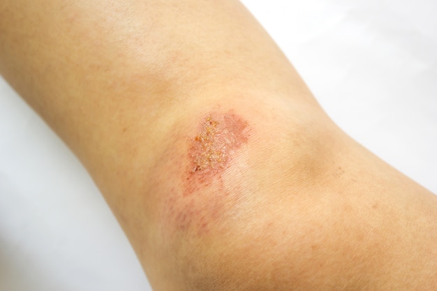 Lesion en la rodilla Antecedentes de salud