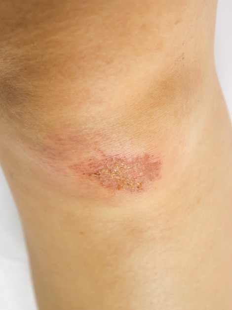 Lesion en la rodilla Antecedentes de salud