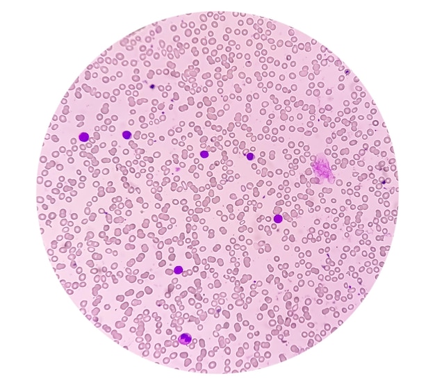 Leucemia linfoblástica aguda o leucemia aguda bajo examen microscópico en laboratorio médico