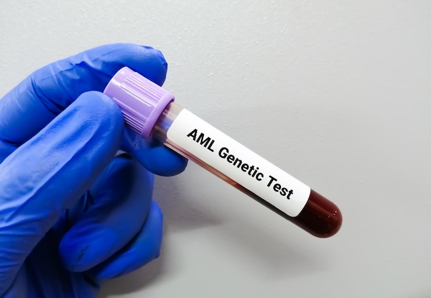 Foto leucemia mieloide aguda ou teste genético de lma