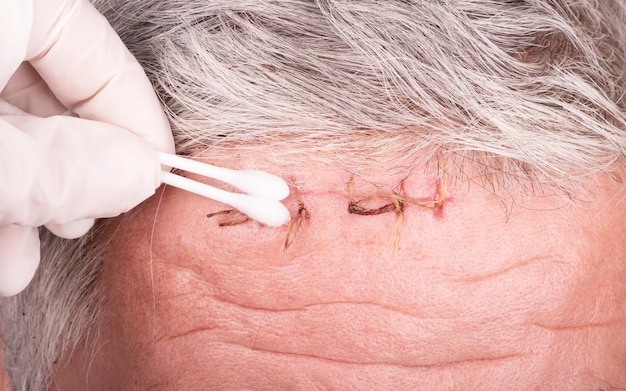 Limpieza de la herida después de suturar con un agente antibacteriano, proceso de cuidado de la herida.