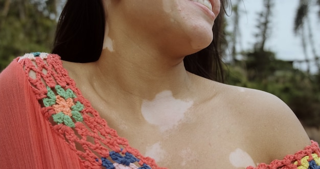 Linda garota latina com vitiligo na praia. dia mundial do vitiligo. distúrbios da pigmentação. despigmentação da pele. doença de pele crônica.