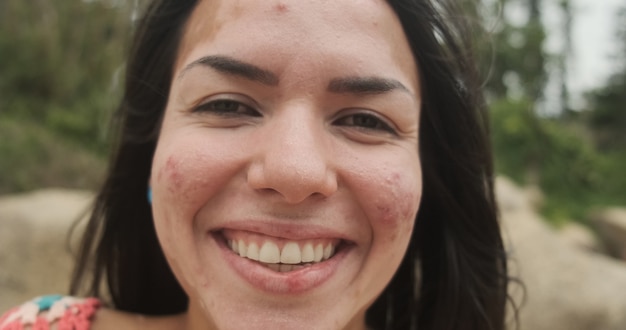 Linda garota latina com vitiligo na praia. Dia Mundial do Vitiligo. Distúrbios da pigmentação. Despigmentação da pele. Doença de pele crônica.