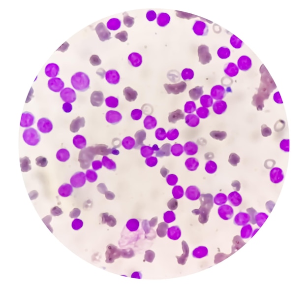 Foto linfoblasto no exame microscópico leucemia linfoblástica aguda all