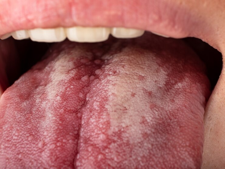 Foto língua com estomatite close-up câncer oral