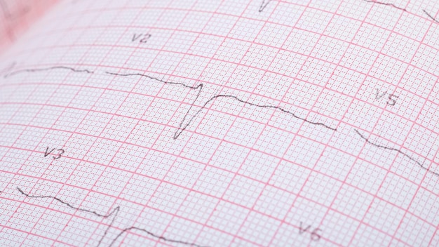 Linhas de cardiograma em papel rosa fecham