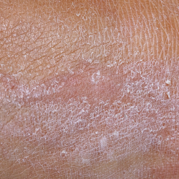 Foto macro da pele seca do corpo de uma mulher
