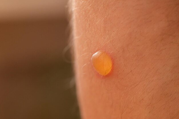 Foto macro de uma pequena bolha redonda na pele após queimadura pés do homem muitos pequenos pêlos queimados de perto