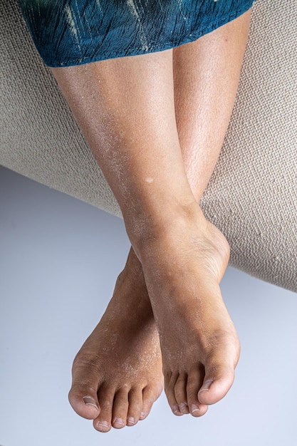 Macro de piel seca de las piernas de una mujer