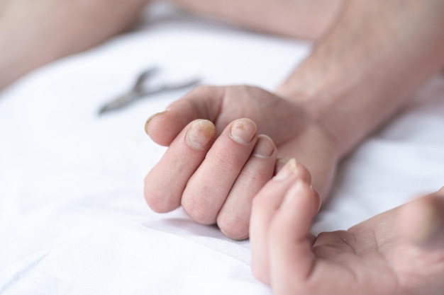 Männliche geschnittene Nägel mit Nagelfungus Pilzinfektion an den Händen Finger mit Onychomycosis Pflege und Behandlung Nahaufnahme einer Hand mit beschädigten Nägeln aufgrund von Pilz