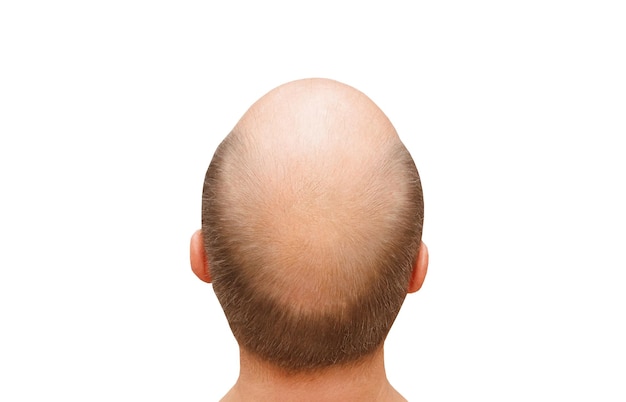 Männlicher Kopf, oberer Teil des Kopfes, spärliches Haar und Geheimratsecken isoliert auf weißem Hintergrund mit Beschneidungspfad