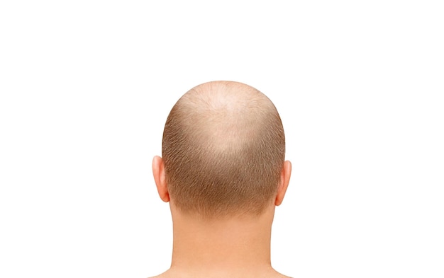 Männlicher Kopf vom Hinterkopf, spärliches Haar und Geheimratsecken isoliert auf weißem Hintergrund mit Beschneidungspfad