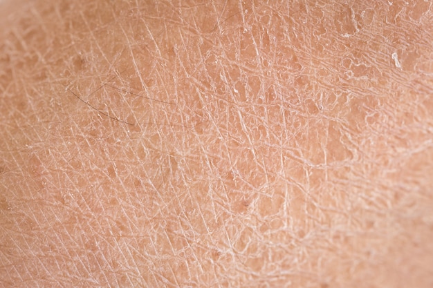 Makro trockene Haut (Ichthyosis) Detail