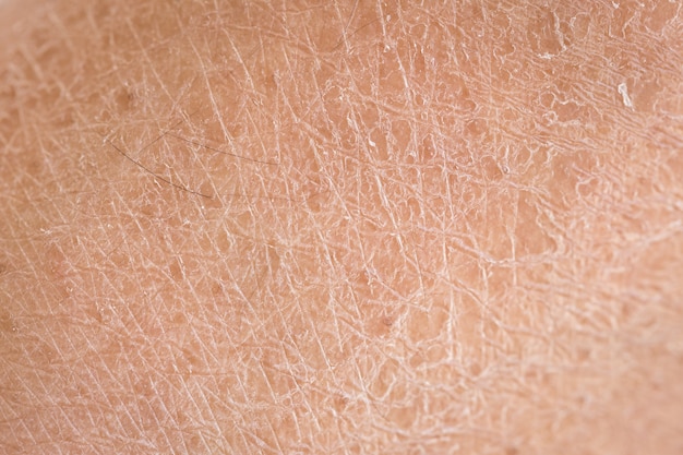 Foto makro trockene haut (ichthyosis) detail