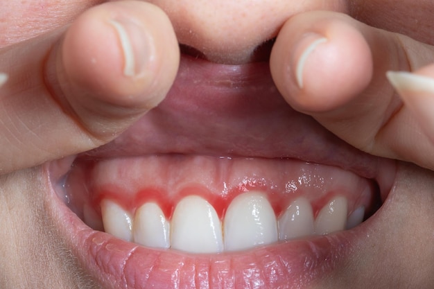 Makroaufnahme des roten Zahnfleisches einer Frau. Zahnfleischentzündung mit Rötung. Schnappschuss einer jungen Frau