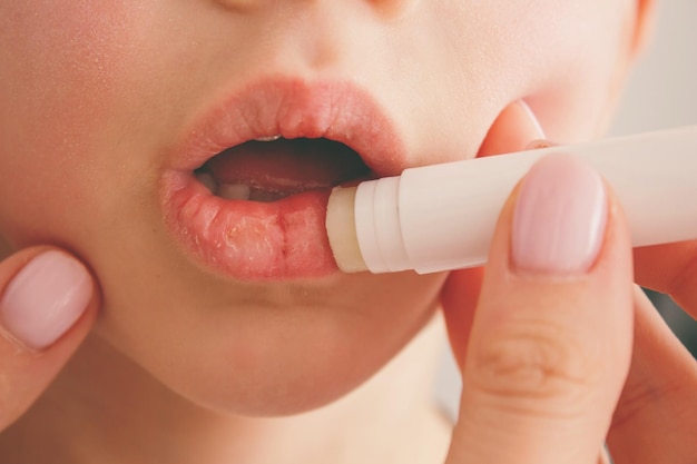 Mamá aplicando lápiz labial a los labios secos de los niños