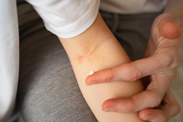 Mamãe aplica a pomada para dermatite na curva do cotovelo de uma garotinha. lesões cutâneas inflamatórias em crianças. cremes e pomadas para o tratamento de irritações da pele. foco seletivo