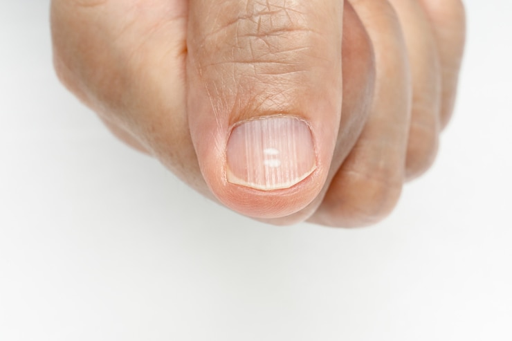 Foto manchas brancas e sulcos verticais nas unhas sintomas deficiência de vitaminas e minerais
